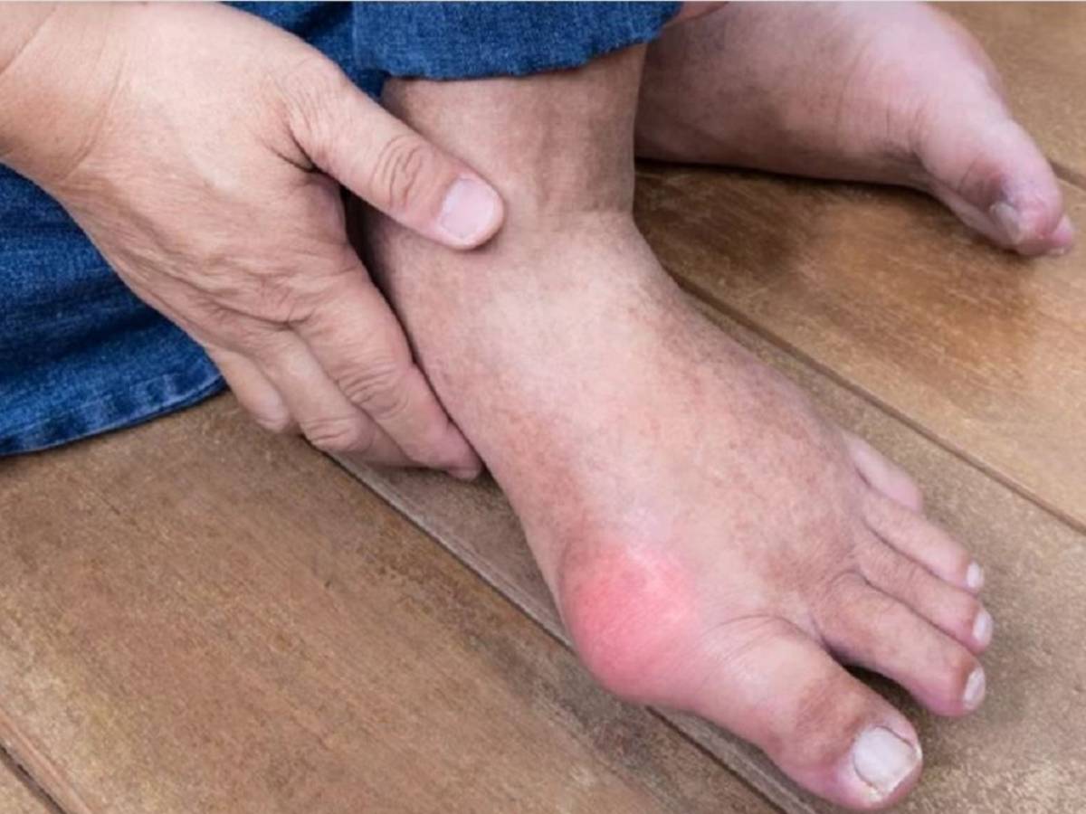 Bệnh gout